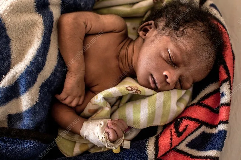 Editorial use only
Sick baby in hospital. Photographed in St Mary's Hospital, Lacor, Gulu, Uganda.