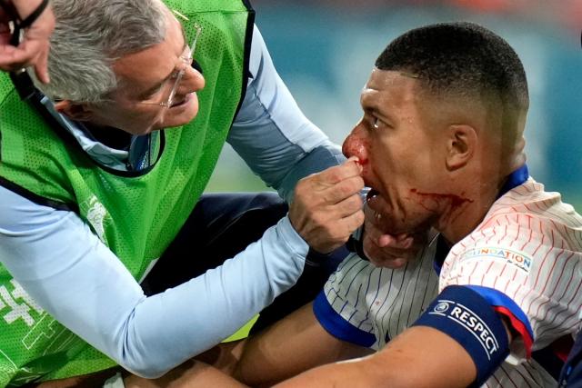 Euro 2024: Mbappe suffers broken nose