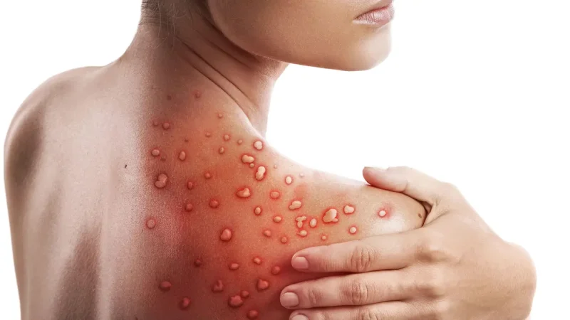 Monkeypox Outbreak: FG to screen inbound international passengers