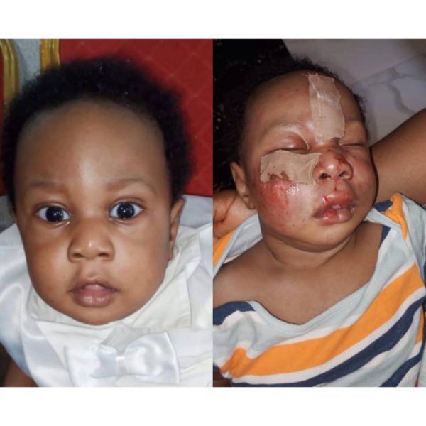 baby injured at daycare