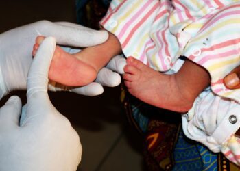 clubfoot treatment in Nigeria