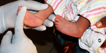 clubfoot treatment in Nigeria