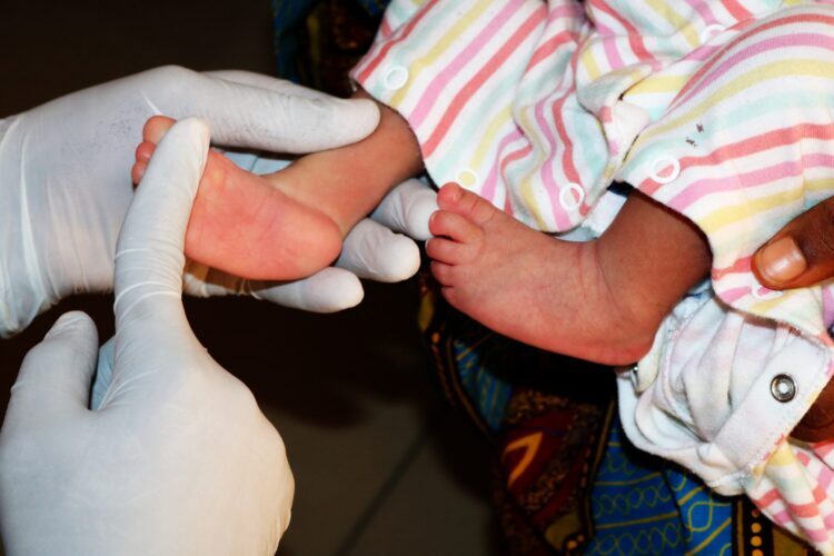 clubfoot treatment in Nigeria